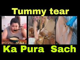 [Update~Now]tummy tear viral X video, tummy tear video online full 4k, tummy tear video orginal mms Leaked